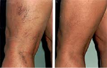 Spider Veins Before and After
